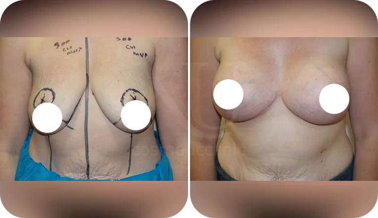 breast lift patient before and after result-1-v1