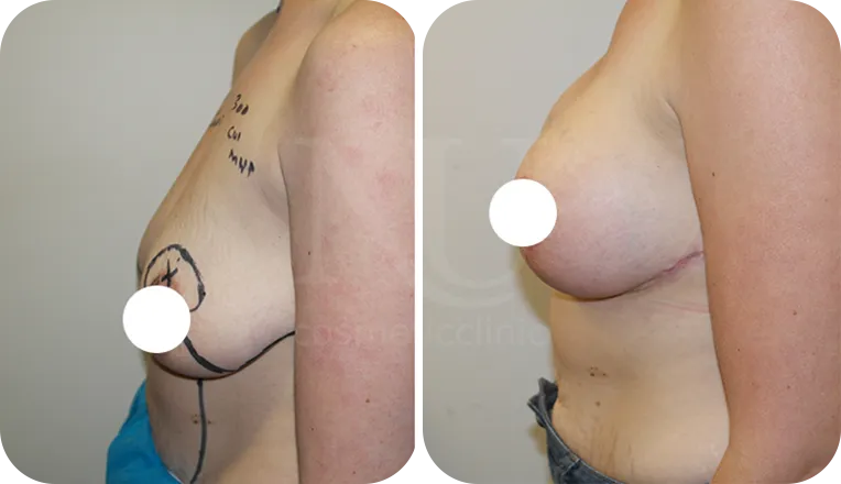 breast lift patient before and after result-1-v2