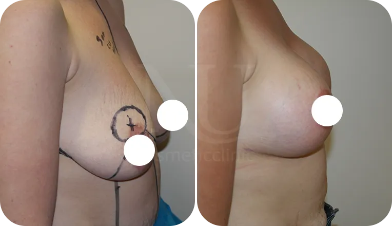 breast lift patient before and after result-1-v3