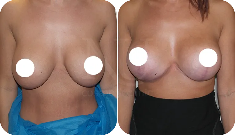 breast lift patient before and after result-2-v1