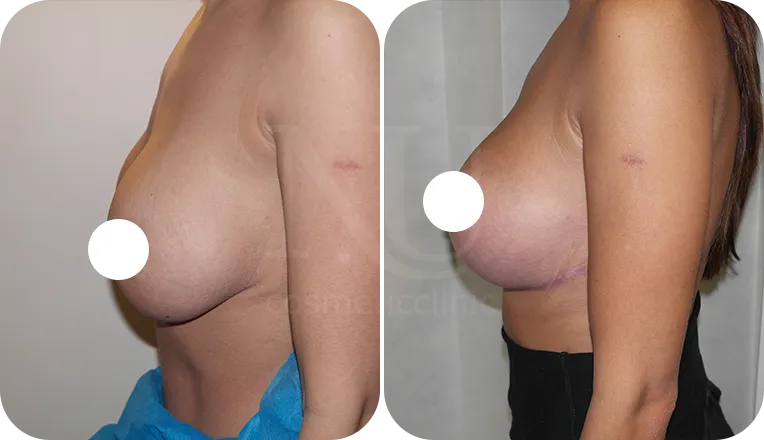 breast lift patient before and after result-2-v2