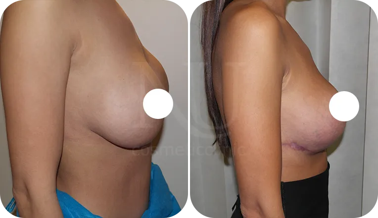 breast lift patient before and after result-2-v3