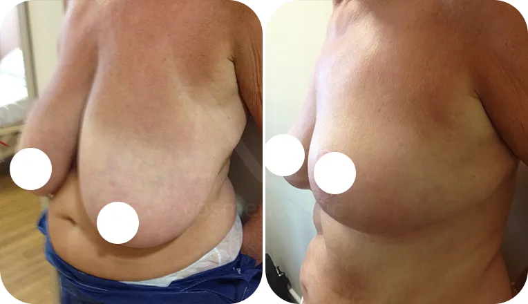 breast reduction patient before and after result-1-v1