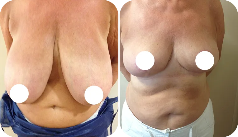 breast reduction patient before and after result-1-v2