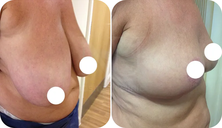 breast reduction patient before and after result-1-v3