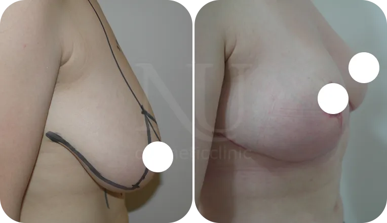 breast reduction patient before and after result-2-v1