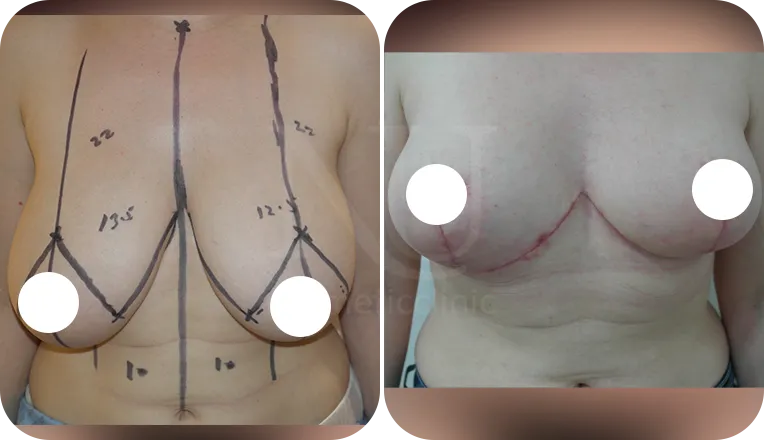 breast reduction patient before and after result-2-v2