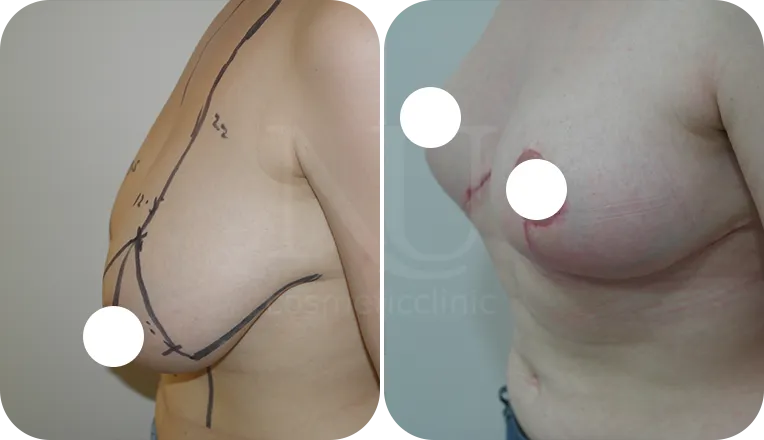 breast reduction patient before and after result-2-v3