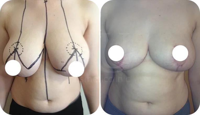 breast reduction patient before and after result-3