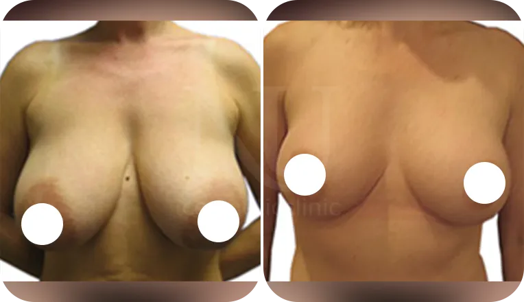 breast reduction surgery patient before and after result-1-v1
