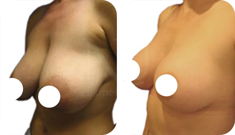 breast reduction surgery patient before and after result-1-v2