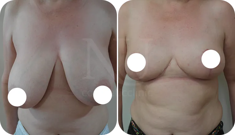 breast reduction surgery patient before and after result-2-v1