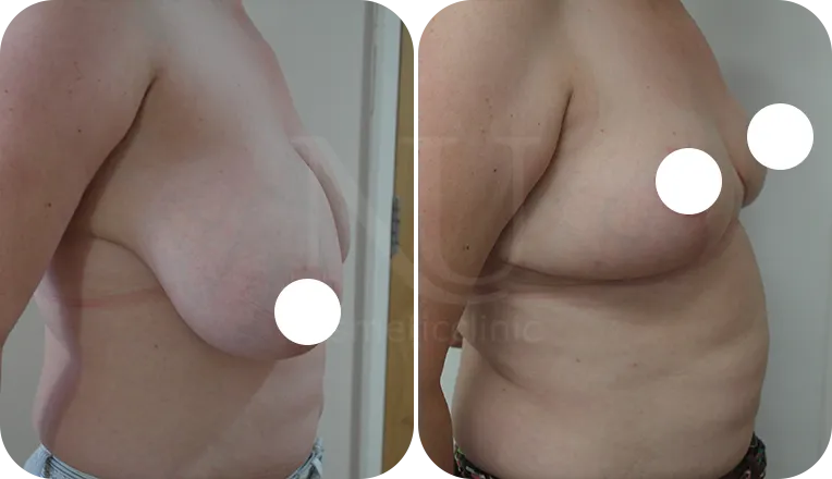 breast reduction surgery patient before and after result-2-v2