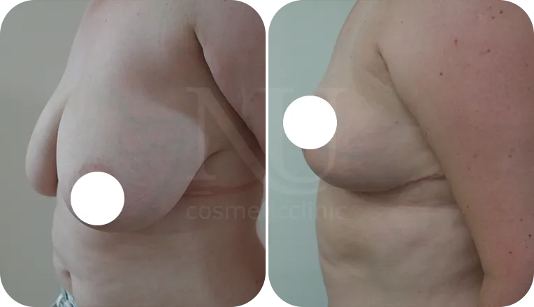 breast reduction surgery patient before and after result-2-v3