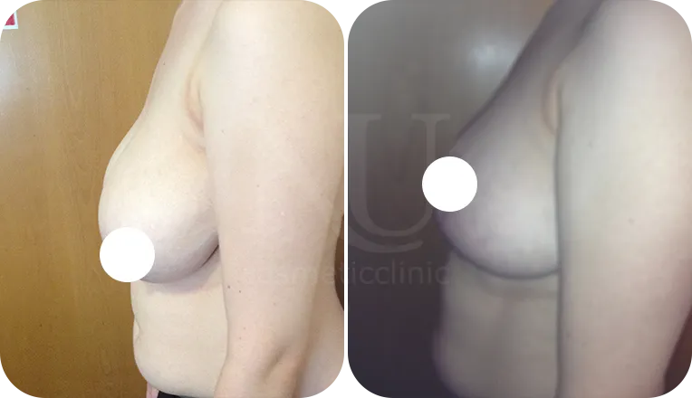breast reduction surgery patient before and after result-3-v1