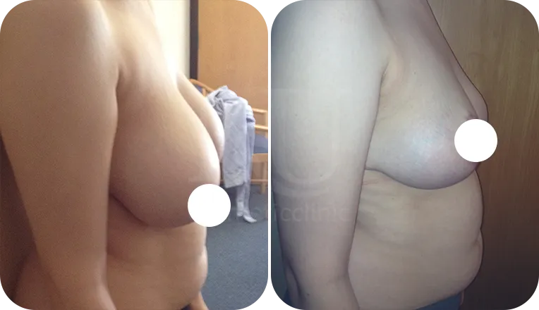 breast reduction surgery patient before and after result-3-v2