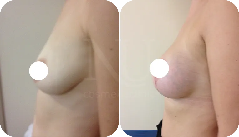 breast uplift patient before and after result-1-v2