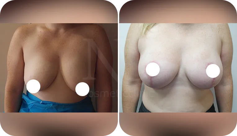 breast uplift patient before and after result-2-v1
