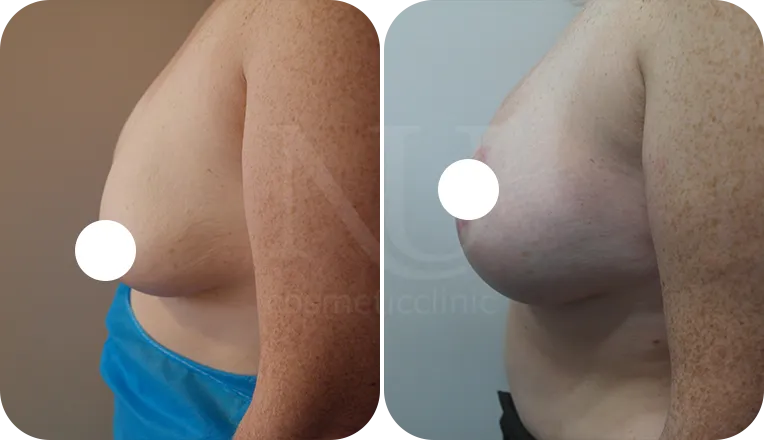 breast uplift patient before and after result-2-v2