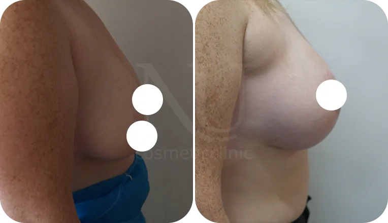 breast uplift patient before and after result-2-v3