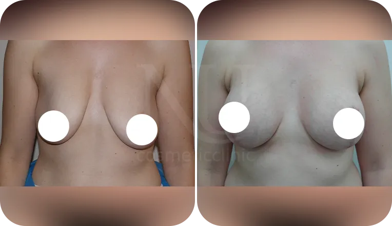 breast uplift patient before and after result-3-v1