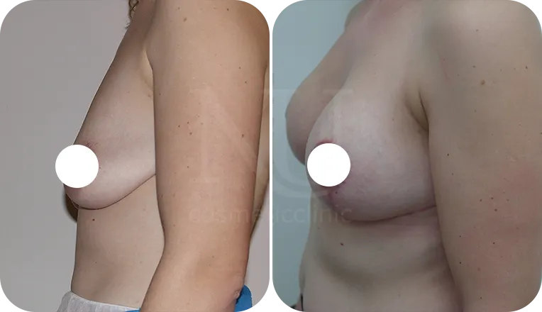 breast uplift patient before and after result-3-v2
