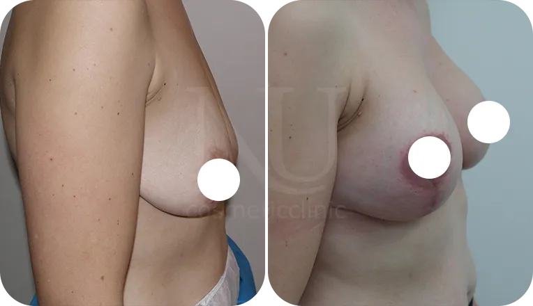 breast uplift patient before and after result-3-v3
