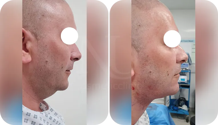 facial lipo patient before and after result-1