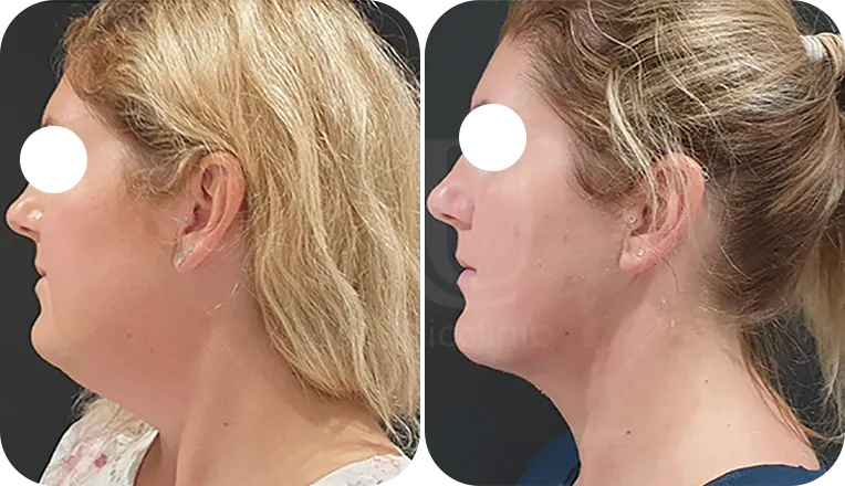 facial liposuction patient before and after result-1-v1