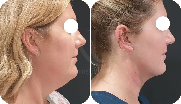facial liposuction patient before and after result-1-v2