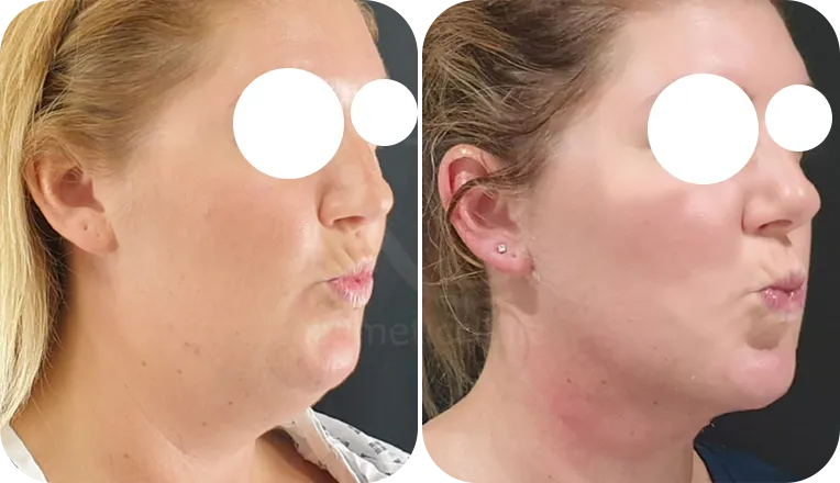facial liposuction patient before and after result-1-v3