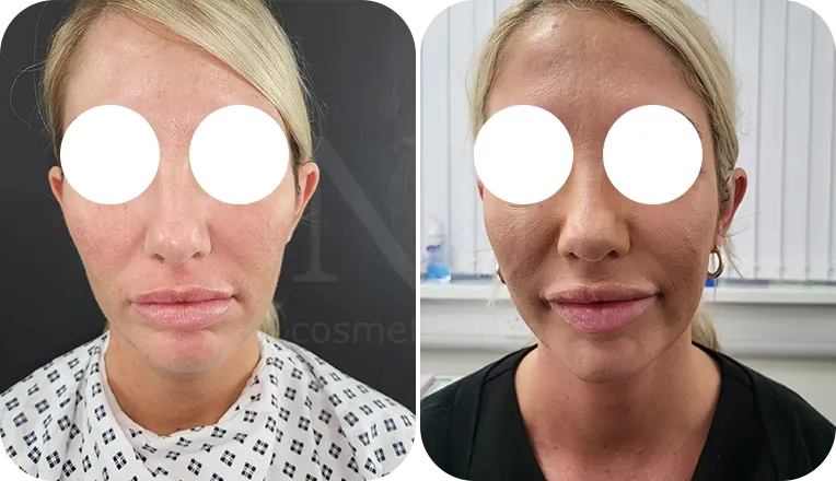 facial liposuction patient before and after result-2-v1