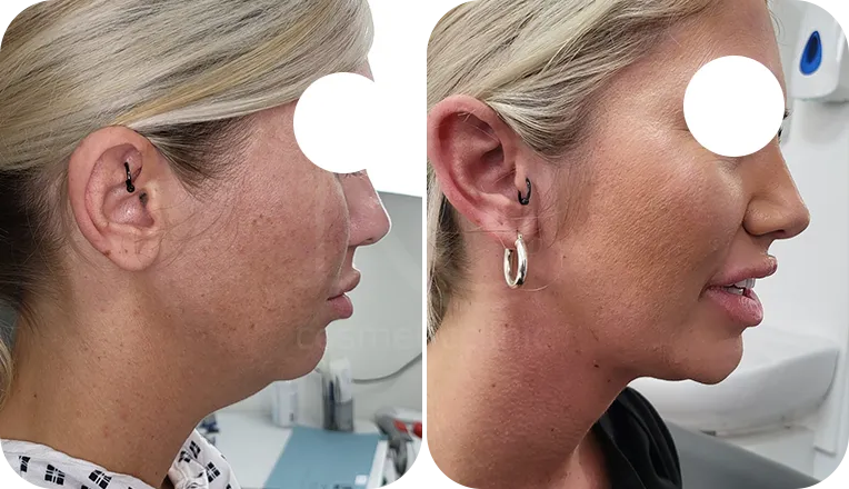 facial liposuction patient before and after result-2-v2