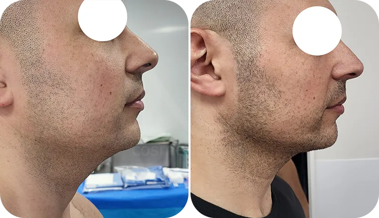 facial liposuction patient before and after result-3-v1