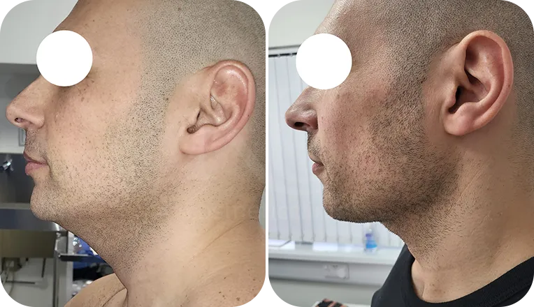 facial liposuction patient before and after result-3-v2
