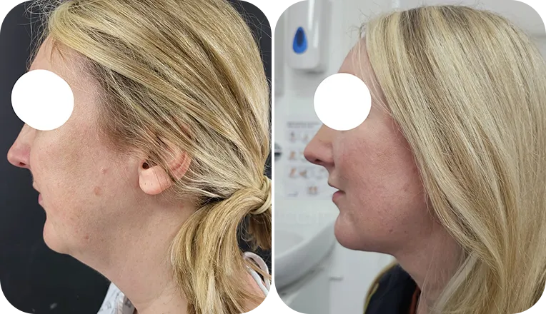 facial liposuction patient before and after result-4-v1