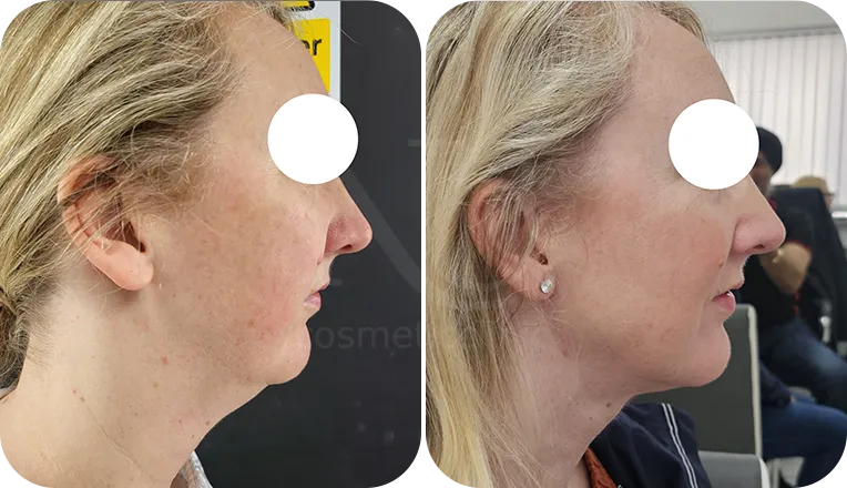 facial liposuction patient before and after result-4-v2