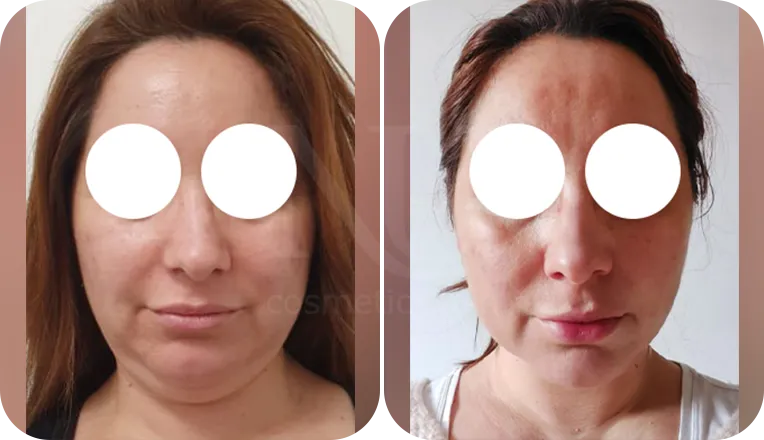 facial vaser lipo patient before and after result-1