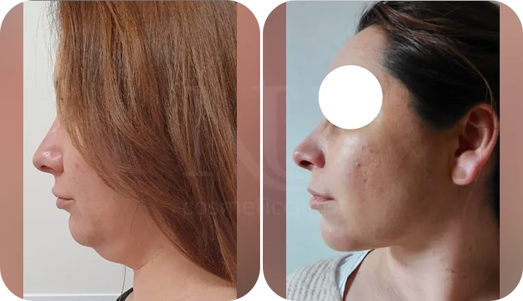 facial vaser lipo patient before and after result-2
