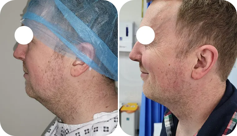 facial vaser lipo patient before and after result