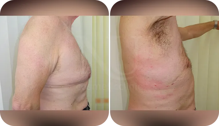 gynaecomastia surgery patient before and after result-1-v1