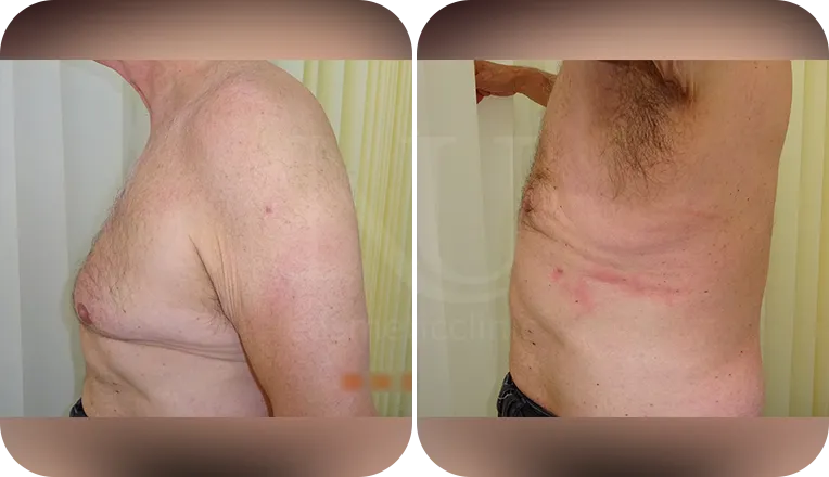 gynaecomastia surgery patient before and after result-1-v2