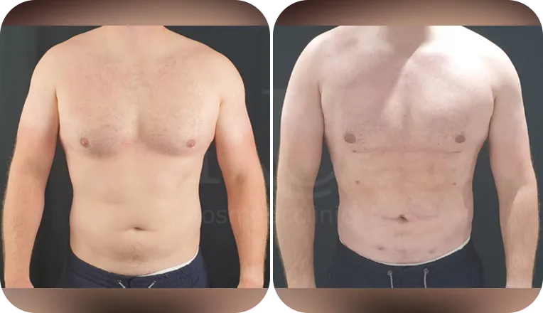 gynaecomastia surgery patient before and after result-2-v1