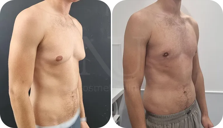 gynaecomastia surgery patient before and after result-2-v2
