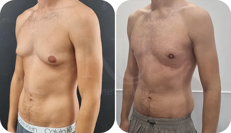 gynaecomastia surgery patient before and after result-2-v3