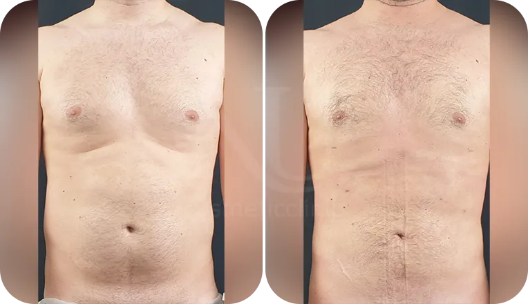 gynaecomastia surgery patient before and after result-3-v1