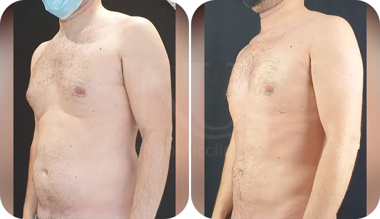 gynaecomastia surgery patient before and after result-3-v2