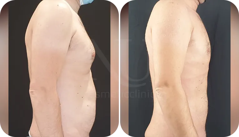 gynaecomastia surgery patient before and after result-3-v3