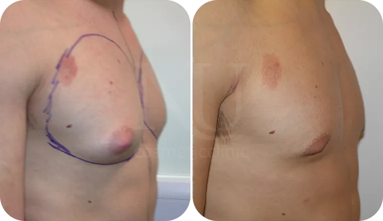 gynaecomastia surgery patient before and after result-4-v2