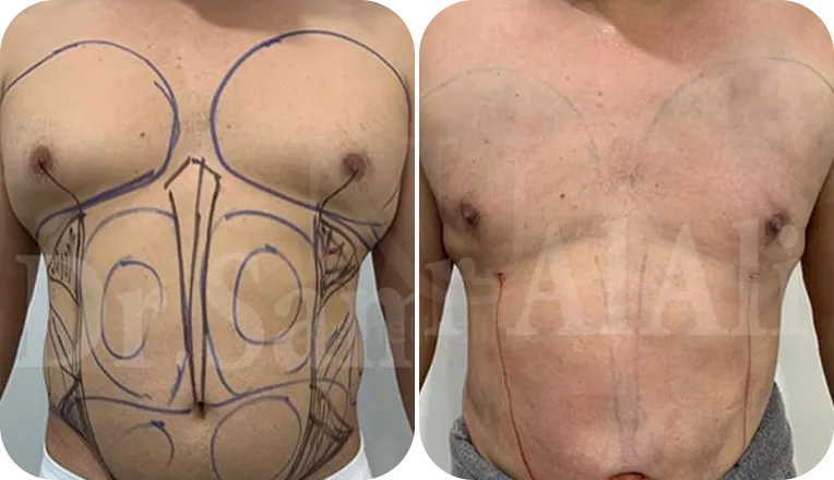 gynaecomastia surgery patient before and after result-5